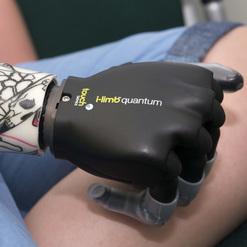 Unterarmprothse von einem Kind mit einer i-limb-quantum- Hand rechts